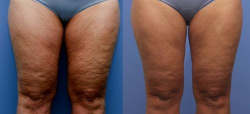 Thighs Before & After Gallery - Patient 58214407 - Image 1