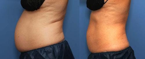 Body Before & After Gallery - Patient 58214408 - Image 5