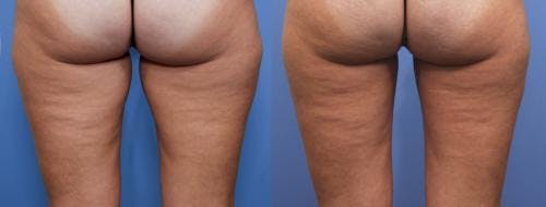 Thighs Before & After Gallery - Patient 58214409 - Image 1