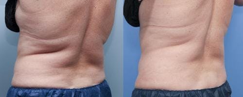 Body Before & After Gallery - Patient 58214412 - Image 4