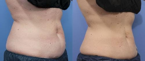 Body Before & After Gallery - Patient 58214414 - Image 1