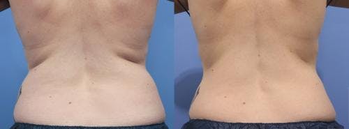 Body Before & After Gallery - Patient 58214414 - Image 2