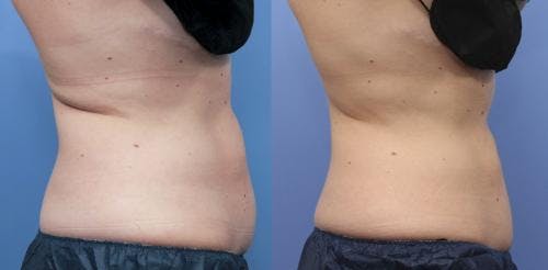 Body Before & After Gallery - Patient 58214414 - Image 4