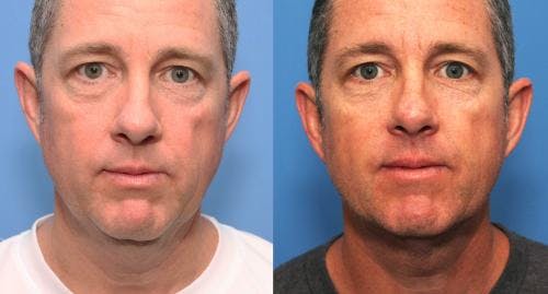 Neck Before & After Gallery - Patient 58214416 - Image 2