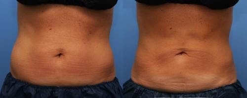 Body Before & After Gallery - Patient 58214423 - Image 1