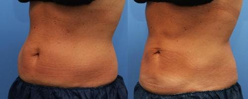Body Before & After Gallery - Patient 58214423 - Image 2