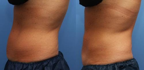 Body Before & After Gallery - Patient 58214423 - Image 3