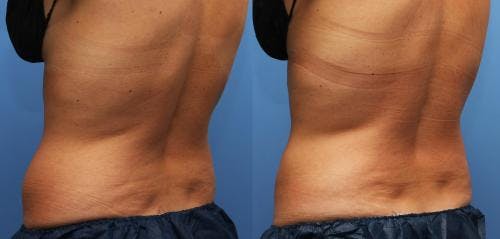 Body Before & After Gallery - Patient 58214423 - Image 4