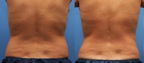Body Before & After Gallery - Patient 58214423 - Image 5