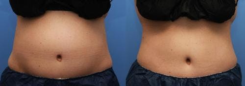 Body Before & After Gallery - Patient 58214424 - Image 1