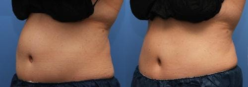 Body Before & After Gallery - Patient 58214424 - Image 2