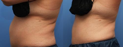 Body Before & After Gallery - Patient 58214424 - Image 3