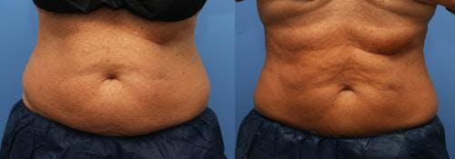 Body Before & After Gallery - Patient 58214425 - Image 1