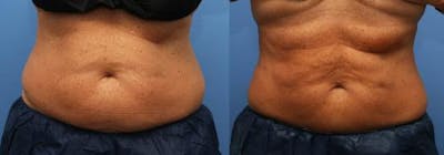 Body Before & After Gallery - Patient 58214425 - Image 1