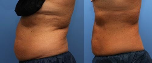 Body Before & After Gallery - Patient 58214425 - Image 3