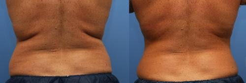 Body Before & After Gallery - Patient 58214425 - Image 4