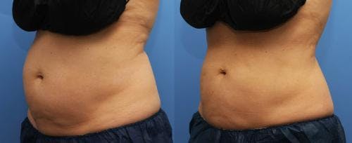 Body Before & After Gallery - Patient 58214427 - Image 1