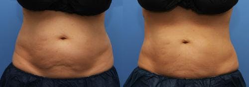 Body Before & After Gallery - Patient 58214427 - Image 2