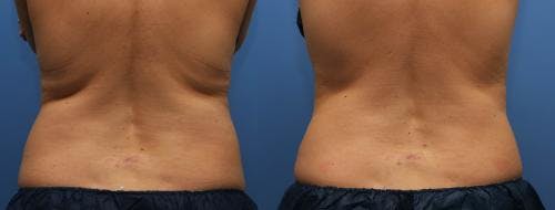 Body Before & After Gallery - Patient 58214427 - Image 3