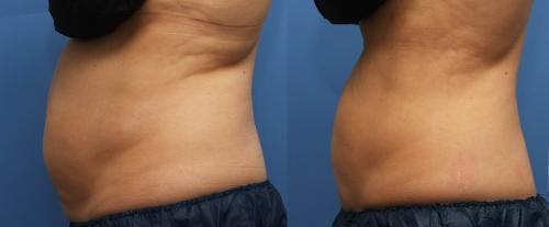 Body Before & After Gallery - Patient 58214427 - Image 4
