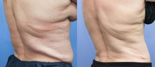 Body Before & After Gallery - Patient 58214428 - Image 2