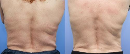 Body Before & After Gallery - Patient 58214428 - Image 3