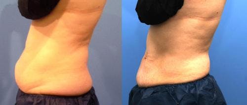 Body Before & After Gallery - Patient 58214429 - Image 2