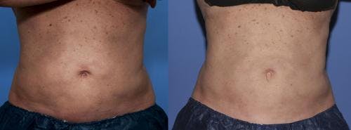 Body Before & After Gallery - Patient 58214431 - Image 2