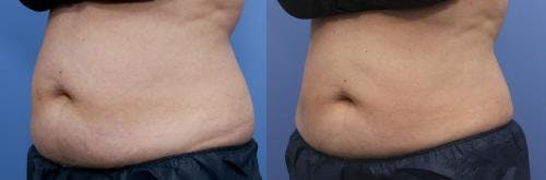 Body Before & After Gallery - Patient 58214432 - Image 1