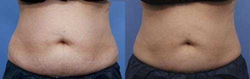 Body Before & After Gallery - Patient 58214432 - Image 3