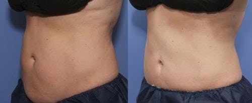Body Before & After Gallery - Patient 58214433 - Image 2