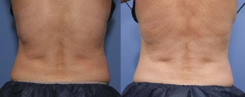 Body Before & After Gallery - Patient 58214433 - Image 3