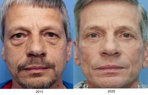 Eyelid Surgery Before & After Gallery - Patient 58216930 - Image 2