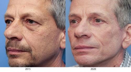 Face Lift Before & After Gallery - Patient 58217402 - Image 1