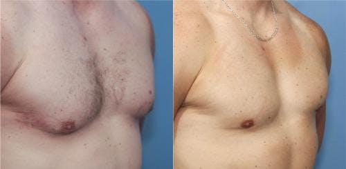 Male Breast Reduction Before & After Gallery - Patient 58217405 - Image 1