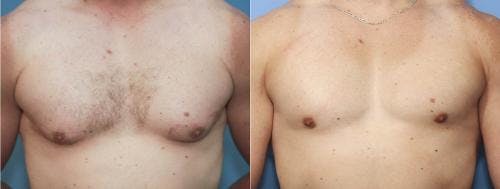 Male Breast Reduction Before & After Gallery - Patient 58217405 - Image 2