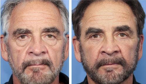 Face Lift Before & After Gallery - Patient 58217896 - Image 1
