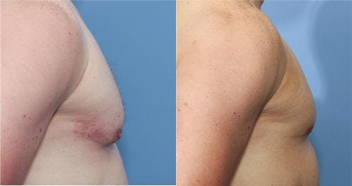 Male Breast Reduction Before & After Gallery - Patient 58217405 - Image 3