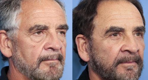 Face Lift Before & After Gallery - Patient 58217896 - Image 2