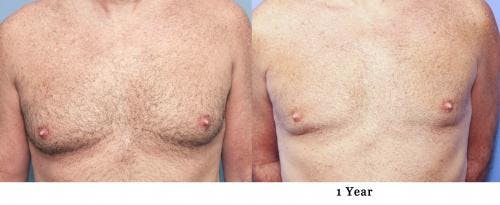 Male Breast Reduction Before & After Gallery - Patient 58217898 - Image 1