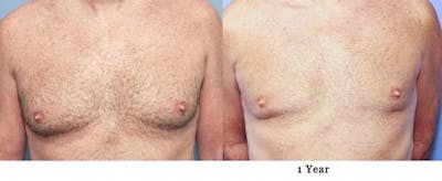 Male Breast Reduction Before & After Gallery - Patient 58217898 - Image 1