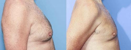 Male Breast Reduction Before & After Gallery - Patient 58217898 - Image 2