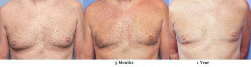 Male Breast Reduction Before & After Gallery - Patient 58217898 - Image 3