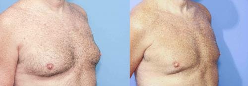Male Breast Reduction Before & After Gallery - Patient 58217898 - Image 4