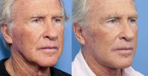 Face Lift Before & After Gallery - Patient 58218363 - Image 2