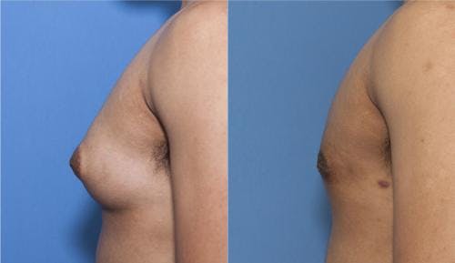 Male Breast Reduction Before & After Gallery - Patient 58218830 - Image 1