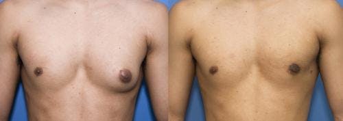 Male Breast Reduction Before & After Gallery - Patient 58218830 - Image 2