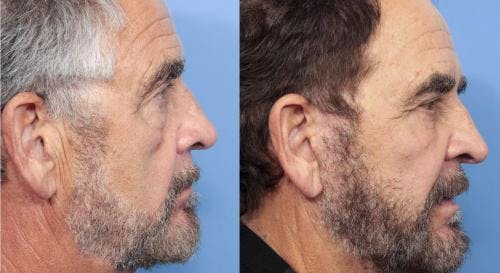 Eyelid Surgery Before & After Gallery - Patient 58218364 - Image 3