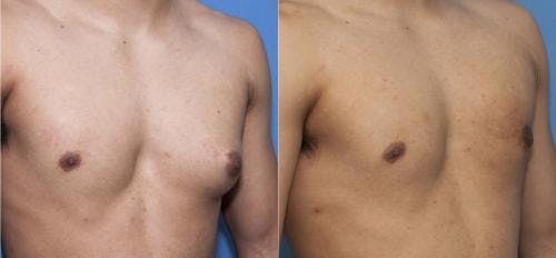 Male Breast Reduction Before & After Gallery - Patient 58218830 - Image 3