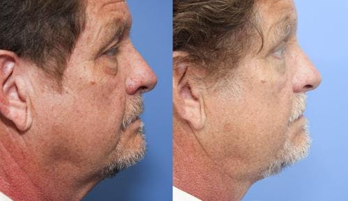 Face Lift Before & After Gallery - Patient 58218832 - Image 2